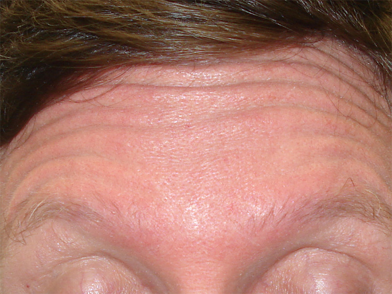 Picture of forehead wrinkles before BOTOX®