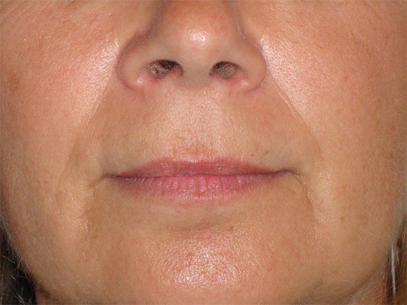 Picture of nasolabial folds before dermal filler