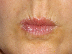 Picture of lines around lips before BOTOX®