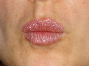 Picture of lines around lips after BOTOX®