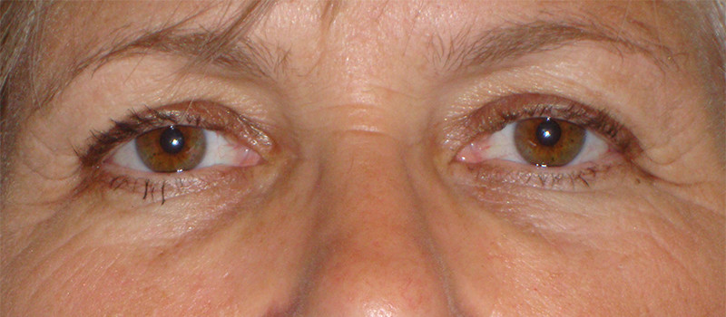 Picture of tired eyes before BOTOX®