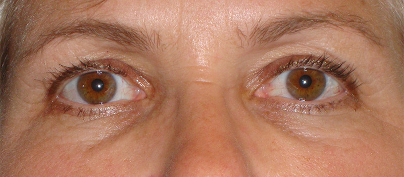 Picture of tired eyes after BOTOX®