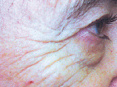 Picture of wrinkles around eyes before laser treatment