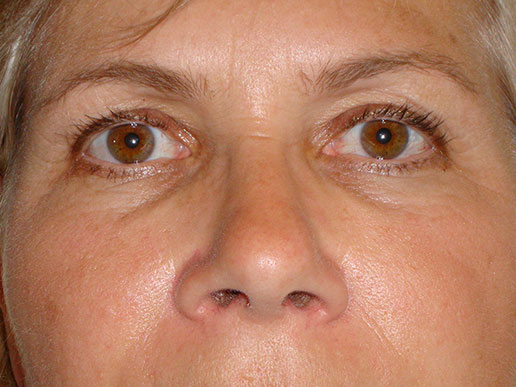 Brow lift photo after Botox Cosmetic