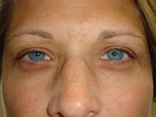 Photo of woman's brow lift after BOTOX® Cosmetic