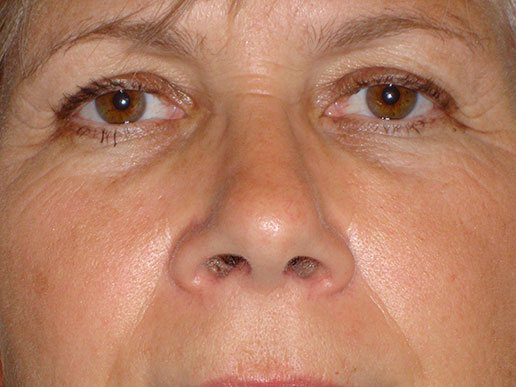 Brow lift photo before Botox Cosmetic