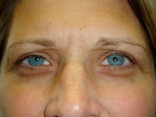 Photo of woman's brow lift before BOTOX® Cosmetic