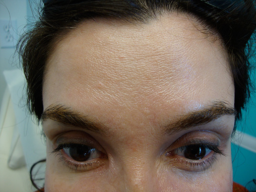 Photo of woman's forehead after BOTOX® Cosmetic