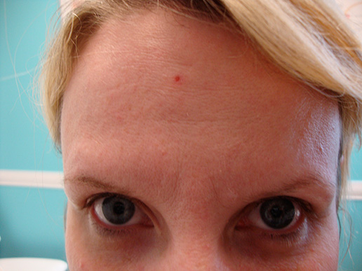 Photo of woman's forehead after BOTOX® Cosmetic