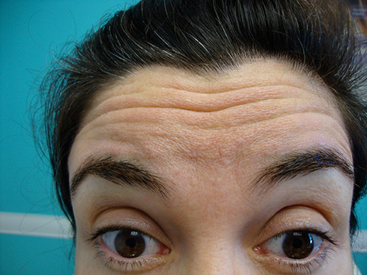 Photo of woman's forehead before BOTOX® Cosmetic