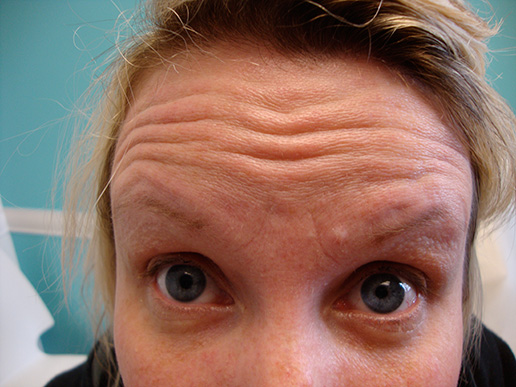 Photo of woman's forehead before BOTOX® Cosmetic