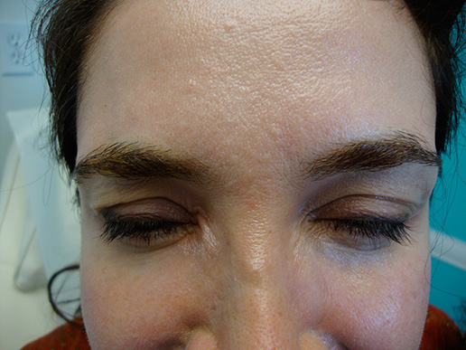 Photo of woman's glabella after BOTOX® Cosmetic