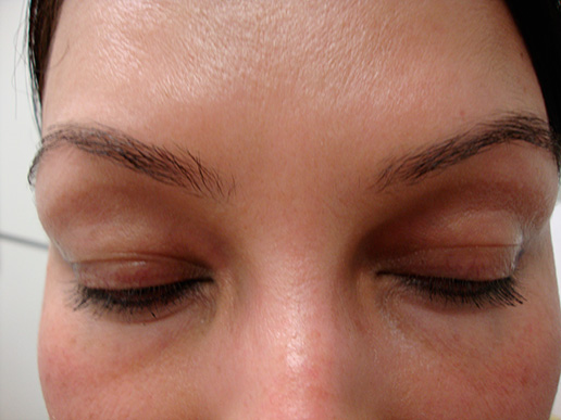 Photo of woman's glabella after BOTOX® Cosmetic