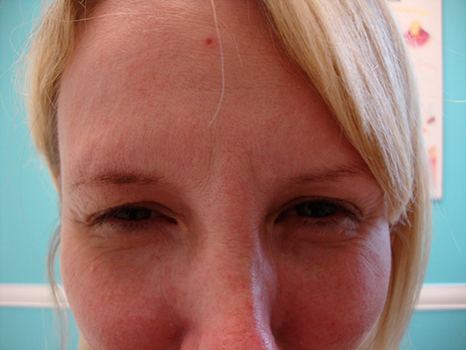 Photo of woman's glabella after BOTOX® Cosmetic