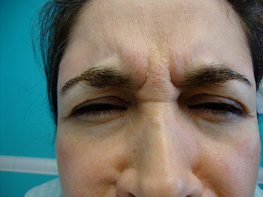 Photo of woman's glabella before BOTOX® Cosmetic