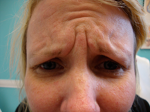 Photo of woman's glabella before BOTOX® Cosmetic