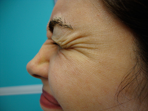 Photo of woman's laugh lines before BOTOX® Cosmetic