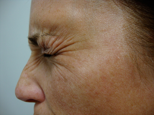 Photo of woman's laugh lines before BOTOX® Cosmetic