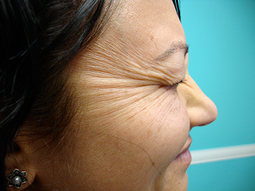 Photo of woman's laugh lines before BOTOX® Cosmetic