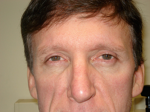 Photo of man's glabella after BOTOX® Cosmetic