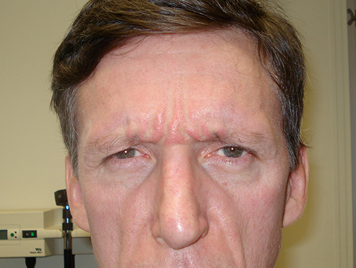 Photo of man's glabella before BOTOX® Cosmetic