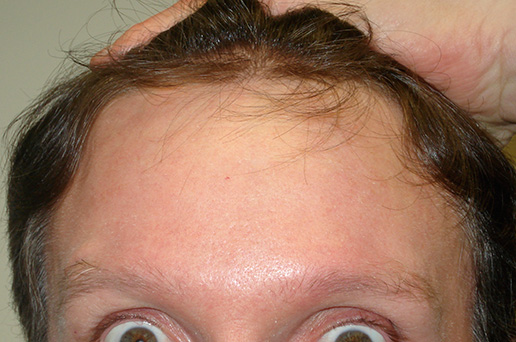 Photo of man's forehead after BOTOX® Cosmetic