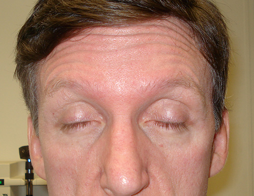 Photo of man's forehead before BOTOX® Cosmetic