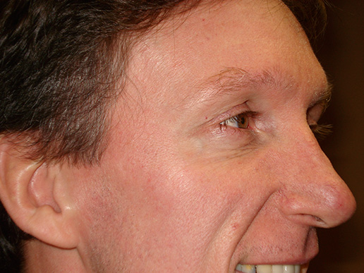 Laugh lines photo after Botox Cosmetic