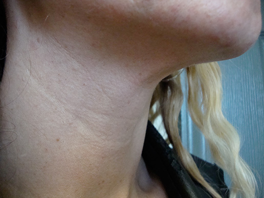 Photo of woman's platysmal bands after BOTOX® Cosmetic