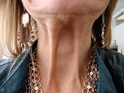 Photo of woman's platysmal bands before BOTOX® Cosmetic