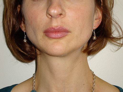 Photo of woman's lip volume after BOTOX® Cosmetic