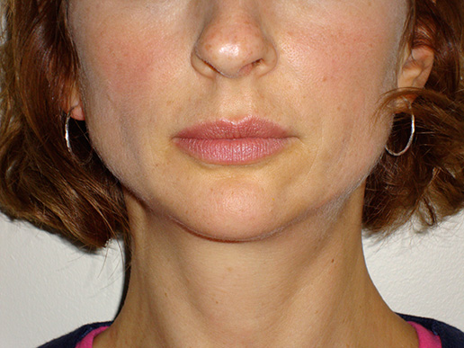 Photo of woman's lip volume before BOTOX® Cosmetic