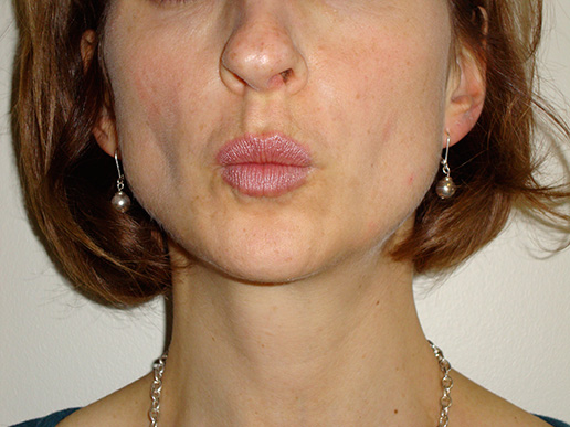 Photo of lines around woman's lips after BOTOX® Cosmetic