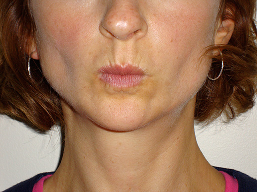 Photo of lines around woman's lips before BOTOX® Cosmetic