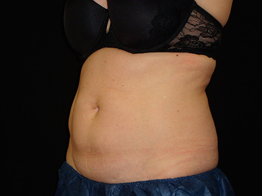 Abdomen after CoolSculpting®