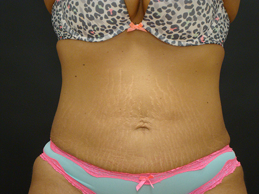 Photo of woman's abdomen after CoolSculpting®