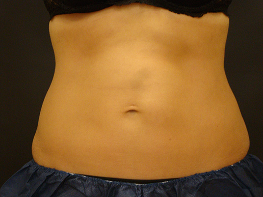 Photo of woman's abdomen after CoolSculpting®