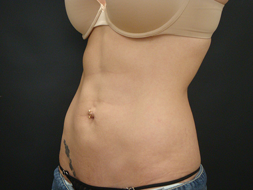 Photo of woman's abdomen after CoolSculpting®