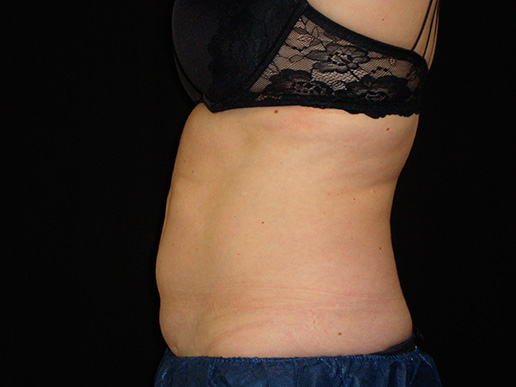 Abdomen after CoolSculpting