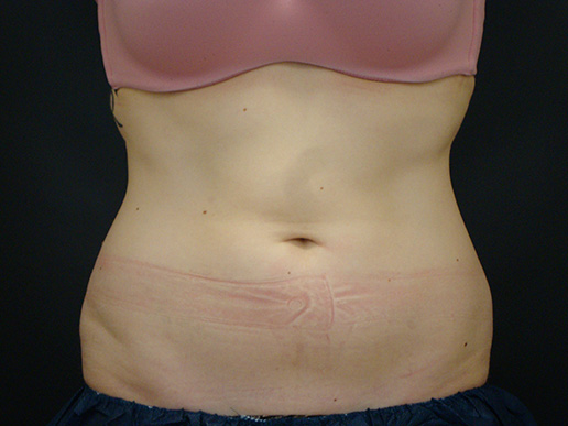 Abdomen after CoolSculpting