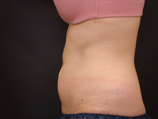 Abdomen after CoolSculpting