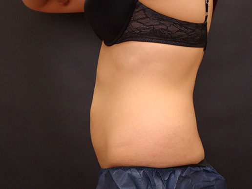 Abdomen after CoolSculpting®