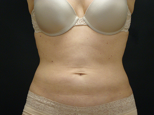 Abdomen after CoolSculpting®