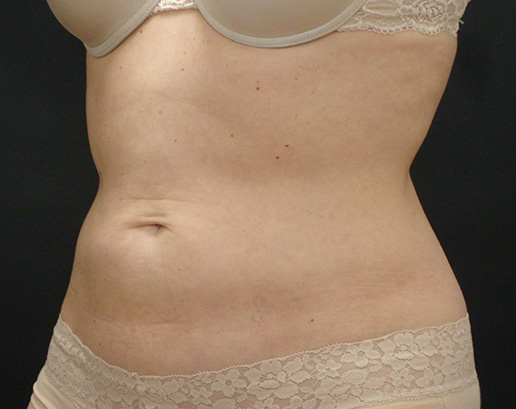 Abdomen after CoolSculpting®