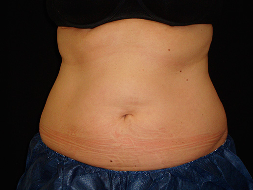 Abdomen after CoolSculpting®