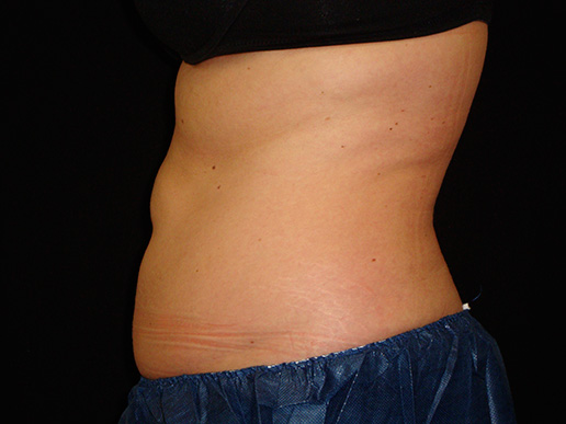 Abdomen after CoolSculpting®