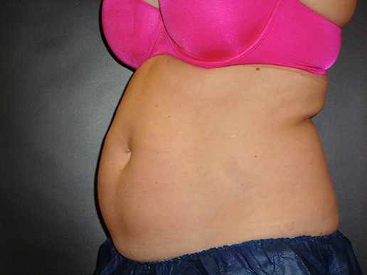 Abdomen before CoolSculpting