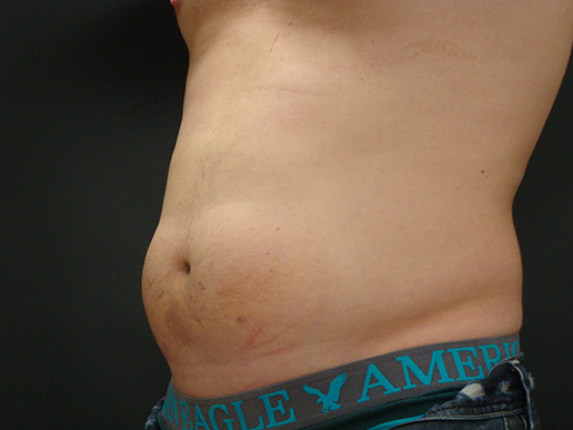 Photo of man's abdomen before CoolSculpting®