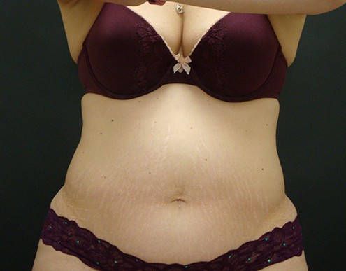 Photo of woman's abdomen before CoolSculpting®