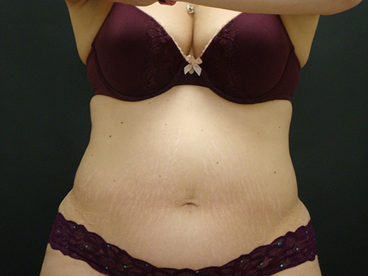 Photo of woman's abdomen before CoolSculpting®